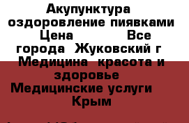 Акупунктура, оздоровление пиявками › Цена ­ 3 000 - Все города, Жуковский г. Медицина, красота и здоровье » Медицинские услуги   . Крым